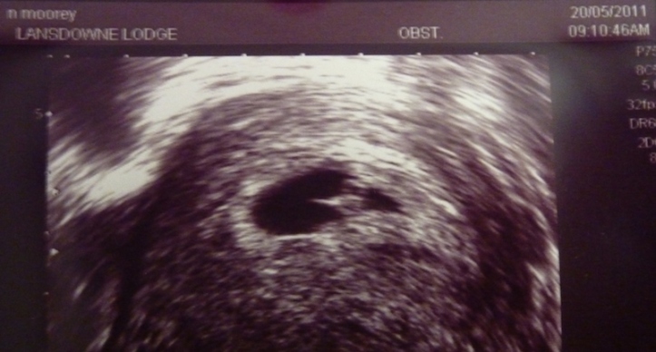 7 week ultrasound scan after fertility treatment